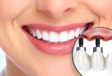 Dental Implant