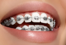 Orthodontic Treatment