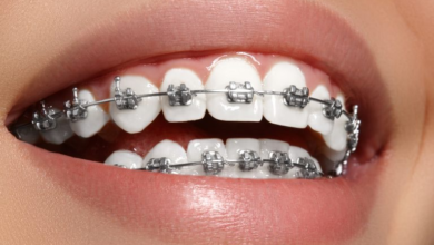 Orthodontic Treatment