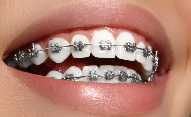 Orthodontic Treatment